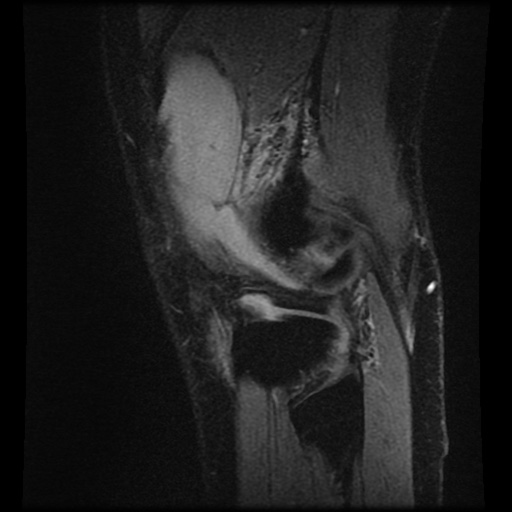 Anterior cruciate ligament tear (Radiopaedia 61500-69462 F 81).jpg