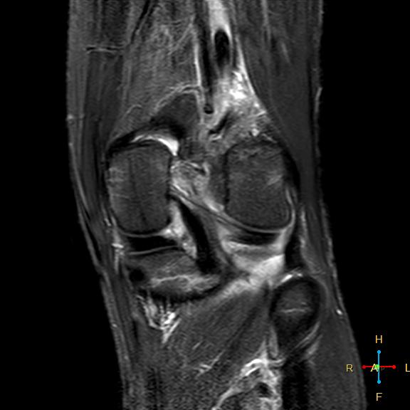 File:Anterior cruciate ligament tear - complete (Radiopaedia 24907-25170 Coronal STIR 15).jpg
