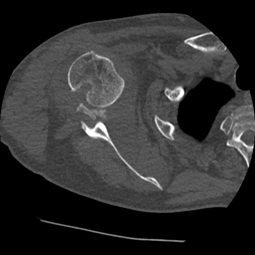 Anterior glenohumeral dislocation with Hill-Sachs lesion (Radiopaedia 62877-71249 Axial bone window 43).jpg