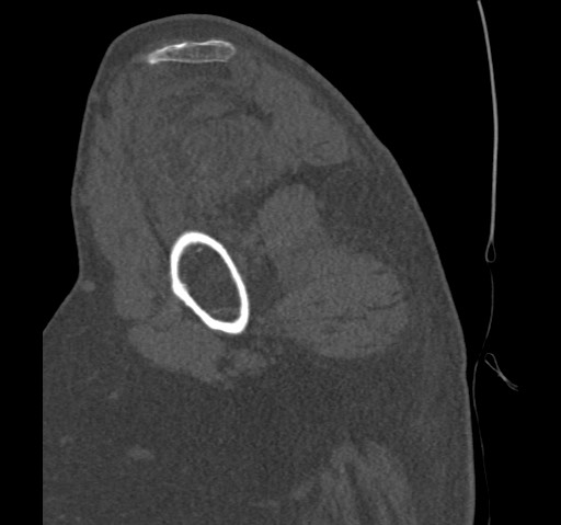 Anterior glenohumeral dislocation with Hill-Sachs lesion (Radiopaedia 62877-71249 Sagittal bone window 21).jpg