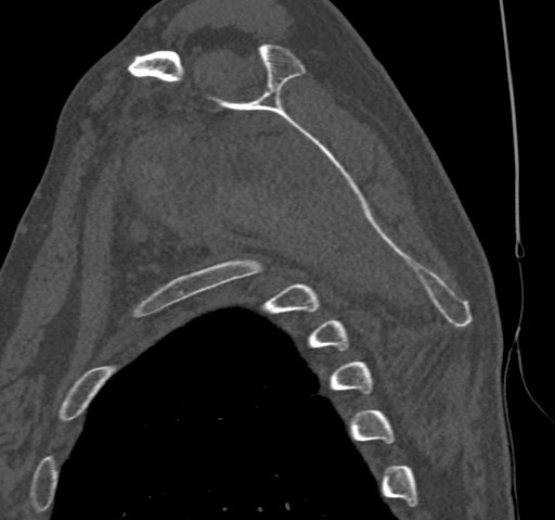Anterior glenohumeral dislocation with Hill-Sachs lesion (Radiopaedia 62877-71249 Sagittal bone window 43).jpg