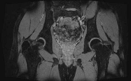 Anterior inferior iliac spine avulsion fracture (Radiopaedia 81312-95000 G 25).jpg
