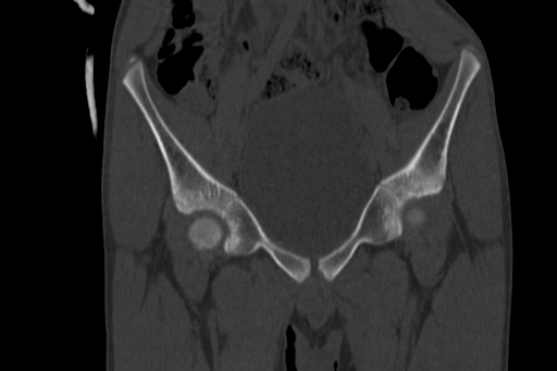 Anterior inferior iliac spine avulsion injury (Radiopaedia 88666-105376 Coronal bone window 25).jpg