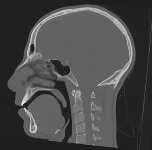 Anterior nasal spine fracture (Radiopaedia 46138-50494 Sagittal bone window 28).png