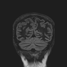 Anterior temporal encephalocele (Radiopaedia 82624-96808 Coronal FLAIR 43).jpg