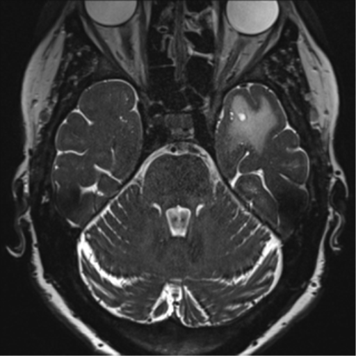 Anterior temporal pole cysts (Radiopaedia 46629-51102 Axial T2 54).png
