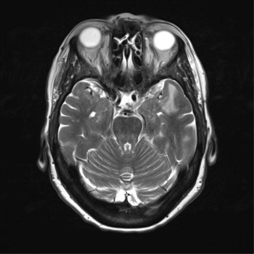 File:Anterior temporal pole cysts (Radiopaedia 46629-51102 C 14).png