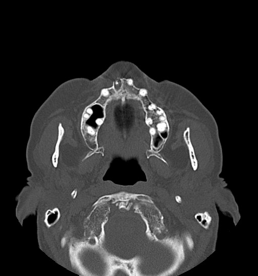 Anterior temporomandibular joint dislocation (Radiopaedia 59430-66784 Axial non-contrast 24).jpg