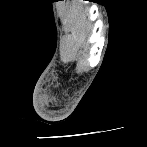 Anterior tibial artery false aneurysm (Radiopaedia 88984-105809 A 238).jpg