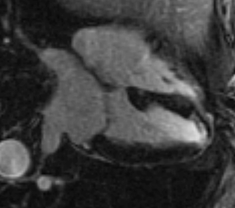 File:Anteroseptal hypokinesia after myocardial infarction (Radiopaedia 15978-15633 G 1).jpg