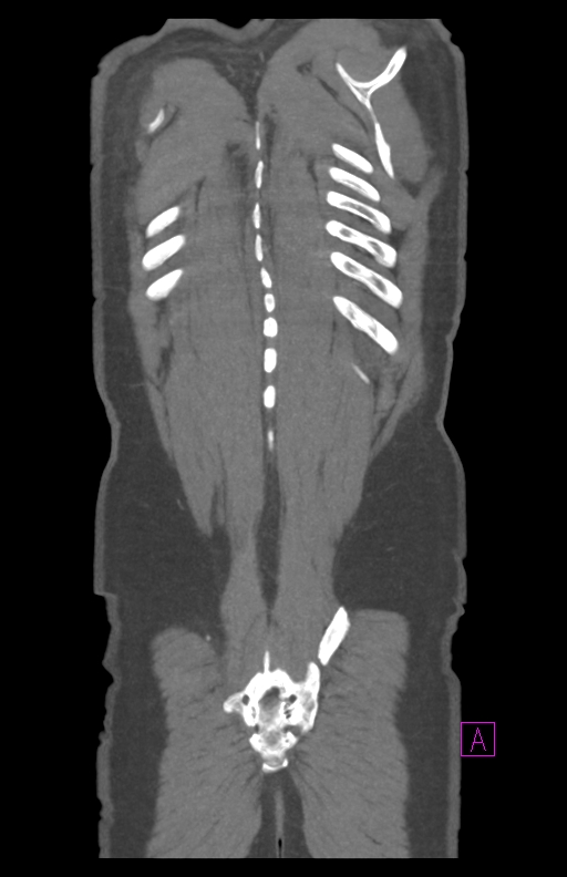 Aortectomy and axillary-bifemoral bypass (Radiopaedia 28303-28545 C 85).jpg