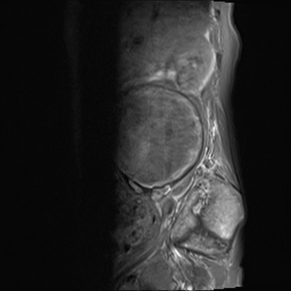 File:Aortic aneurysm with spinal destruction (Radiopaedia 42301-45409 Sagittal T1 fat sat 13).jpg