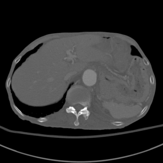 Aortic aneurysm with spinal destruction (Radiopaedia 42301-45410 Axial bone window 18).jpg