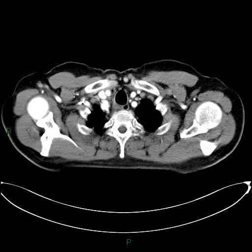Aortic arch origin of left vertebral artery (Radiopaedia 46327-50737 Axial post contrast 13).jpg