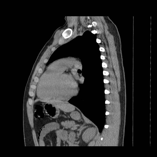 File:Aortic arch stent (Radiopaedia 30030-30595 B 20).jpg