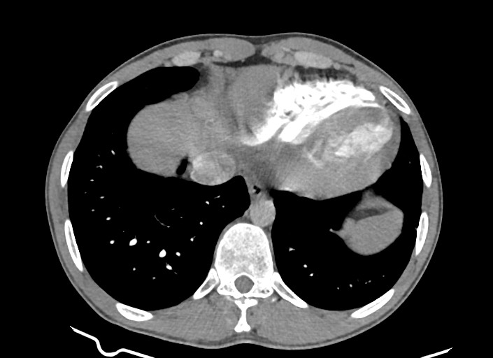 File:Aortic coarctation with aneurysm (Radiopaedia 74818-85828 A 57).jpg