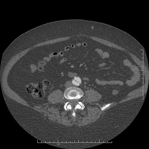 File:Aortic dissection- Stanford A (Radiopaedia 35729-37268 C 35).jpg