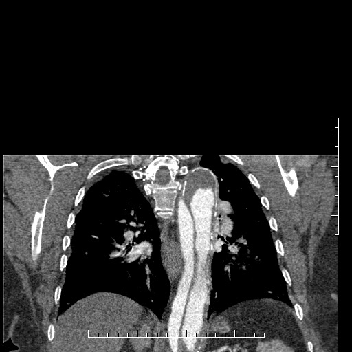 Aortic dissection- Stanford A (Radiopaedia 35729-37268 E 10).jpg