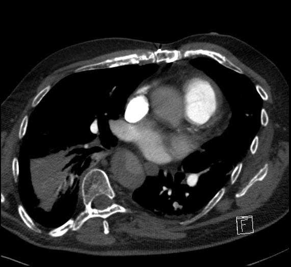 File:Aortic dissection (CTPA) (Radiopaedia 75506-86751 Axial C+ CTPA 76).jpg