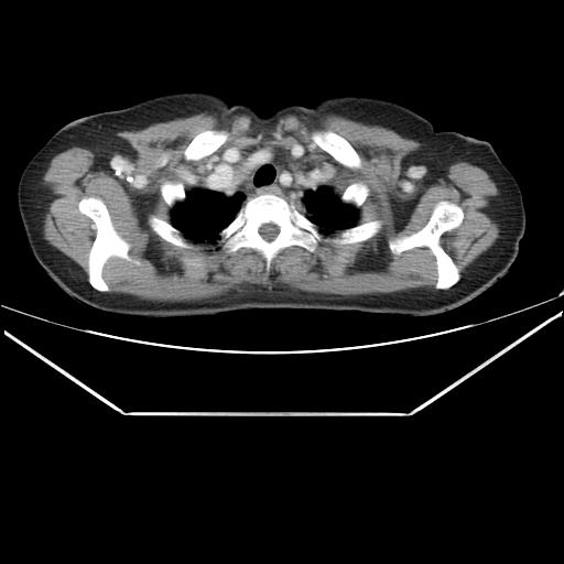 Aortic dissection (Radiopaedia 25350-25604 C 3).jpg