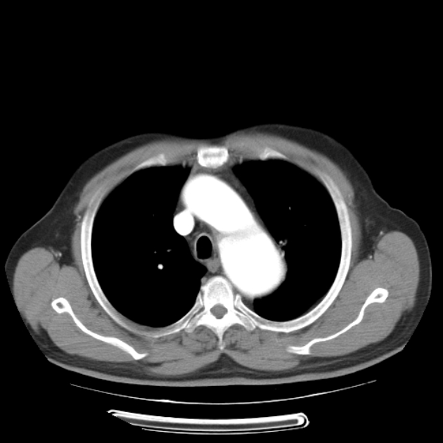 Aortic dissection (Radiopaedia 44411-48061 C 8).jpg
