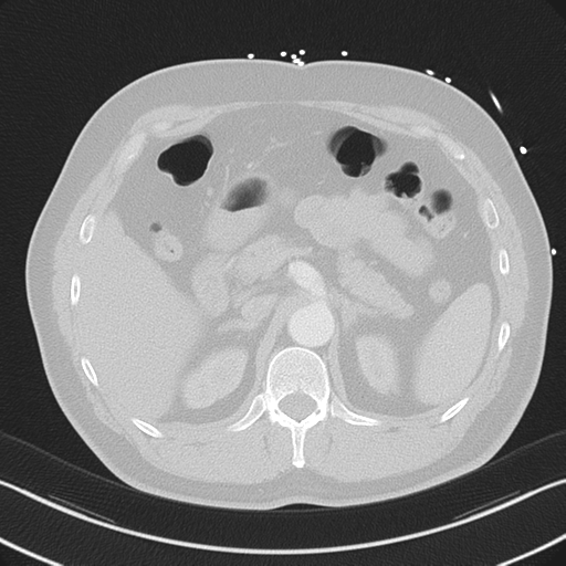 File:Aortic dissection (Radiopaedia 50763-56234 Axial lung window 67).png