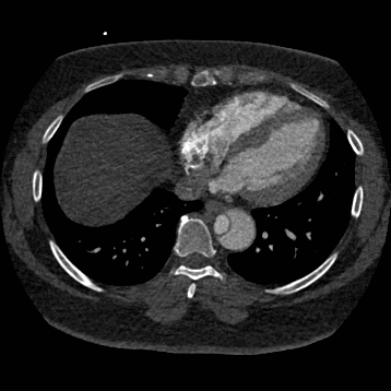 Aortic dissection (Radiopaedia 57969-64959 A 212).jpg