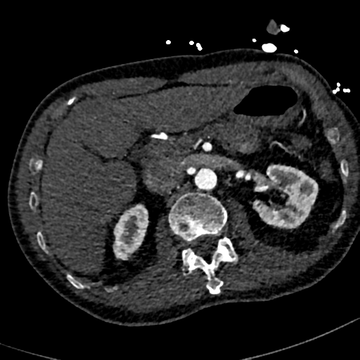 File:Aortic dissection - DeBakey type II (Radiopaedia 64302-73082 A 97).png