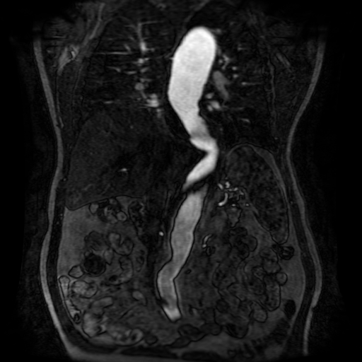 File:Aortic dissection - Stanford A - DeBakey I (Radiopaedia 23469-23551 D 134).jpg