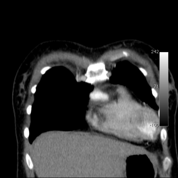 Aortic dissection - Stanford type A (Radiopaedia 29247-29659 B 13).jpg