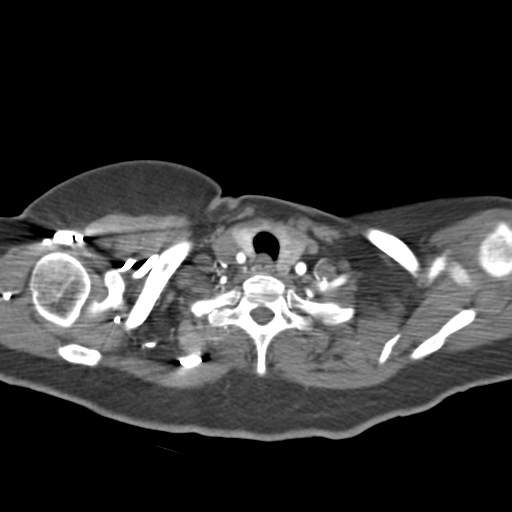File:Aortic dissection - Stanford type A (Radiopaedia 39073-41259 A 3).png
