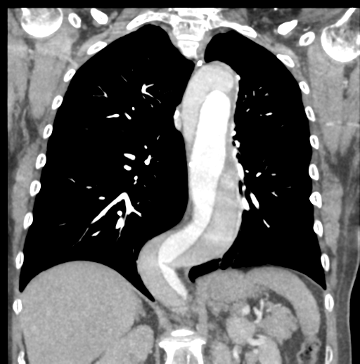 File:Aortic dissection - Stanford type B (Radiopaedia 50171-55512 B 53).png