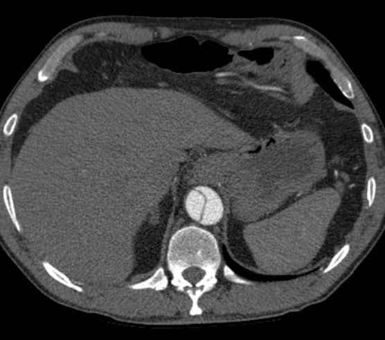 Aortic dissection - Stanford type B (Radiopaedia 73648-84437 A 105).jpg