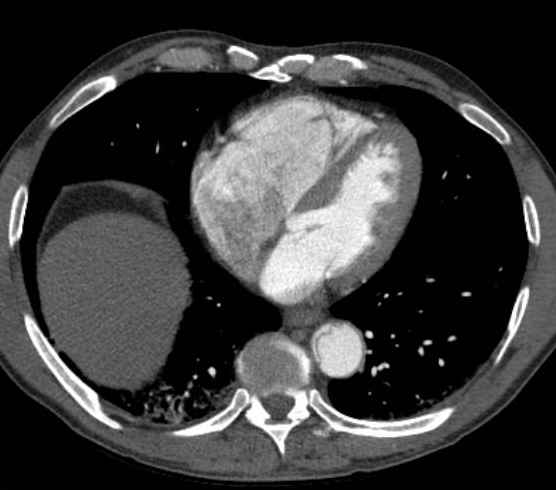 File:Aortic dissection - Stanford type B (Radiopaedia 73648-84437 A 77).jpg