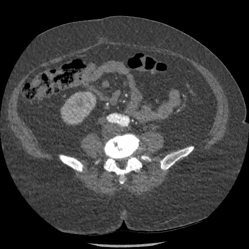 Aortic dissection - Stanford type B (Radiopaedia 88281-104910 A 131).jpg
