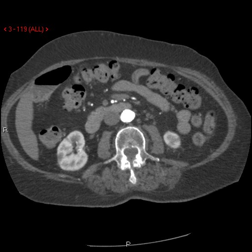 Aortic intramural hematoma (Radiopaedia 27746-28001 A 119).jpg