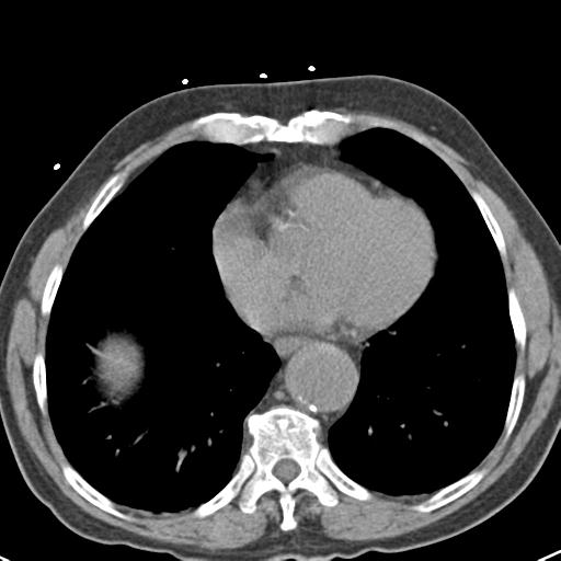 Aortic intramural hematoma (Radiopaedia 31139-31838 Axial non-contrast 37).jpg