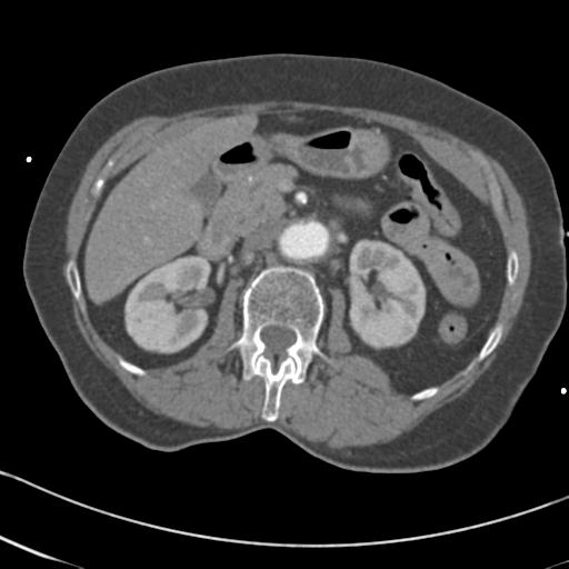 Aortic intramural hematoma from penetrating atherosclerotic ulcer (Radiopaedia 31137-31836 A 97).jpg
