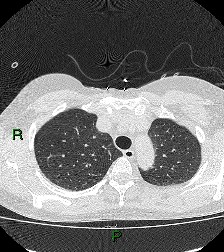 File:Aortic valve endocarditis (Radiopaedia 87209-103485 Axial lung window 26).jpg