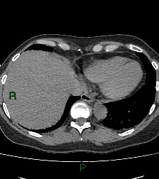 Aortic valve endocarditis (Radiopaedia 87209-103485 Axial non-contrast 80).jpg