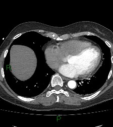 Aortic valve endocarditis (Radiopaedia 87209-103485 C 65).jpg