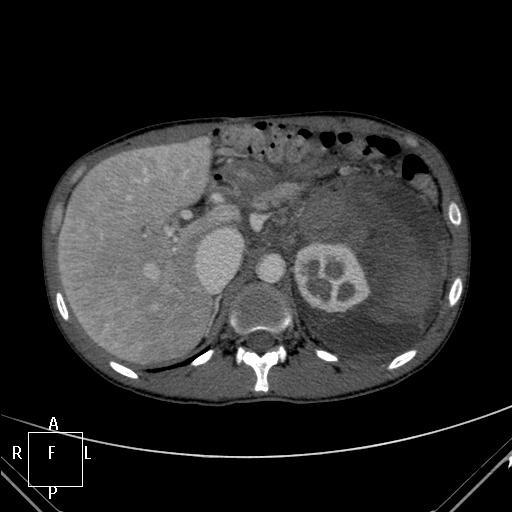 File:Aorto-left renal vein fistula (Radiopaedia 45534-49628 A 6).jpg