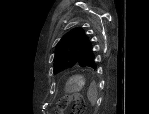 Aortoesophageal fistula with endovascular repair (Radiopaedia 73781-84592 Sagittal C+ CTPA 174).jpg