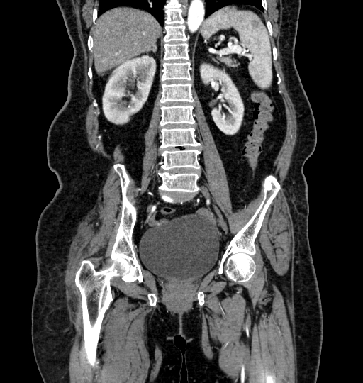 Aortoiliac occlusive disease (Radiopaedia 52352-58248 B 43).jpg