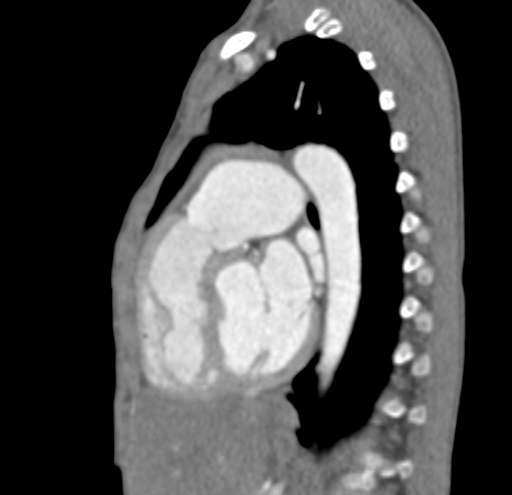 File:Aortopulmonary window, interrupted aortic arch and large PDA giving the descending aorta (Radiopaedia 35573-37074 C 26).jpg