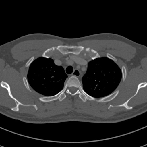 Apical lung mass mimic - neurogenic tumor (Radiopaedia 59918-67521 Axial bone window 16).jpg
