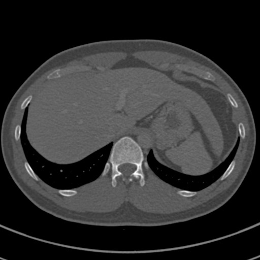 Apical lung mass mimic - neurogenic tumor (Radiopaedia 59918-67521 Axial bone window 75).jpg