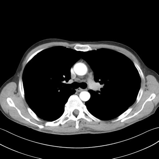 Apical pleural calcification (Radiopaedia 46141-50499 Axial C+ delayed 26).png