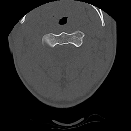 Apical pneumothorax on cervical spine CT (Radiopaedia 45343-49368 Axial bone window 20).jpg