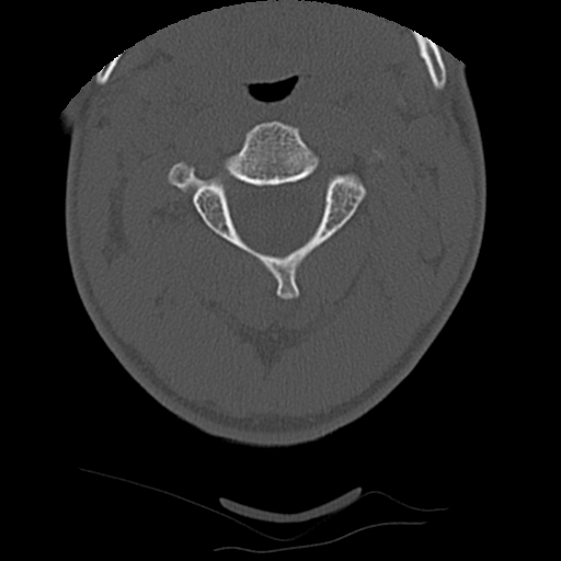File:Apical pneumothorax on cervical spine CT (Radiopaedia 45343-49368 Axial bone window 25).jpg
